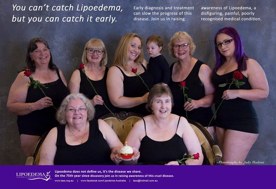 What are some treatment options for lipedema?